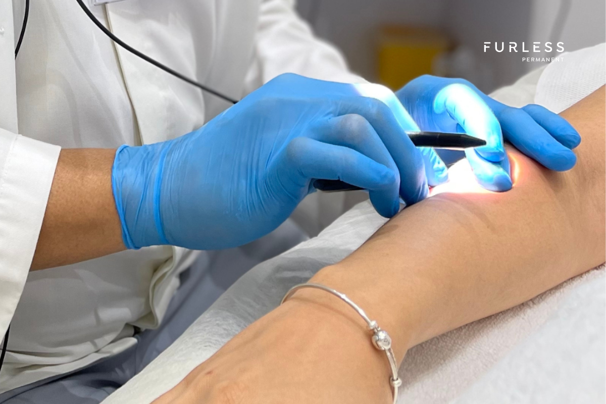 Therapist performing electrolysis hair removal on a client's forearm using a fine probe